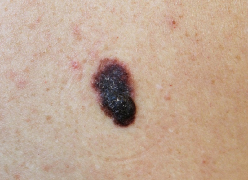 Câncer de pele - melanoma
