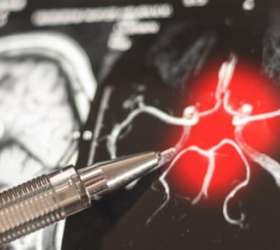 Exame de sangue para Alzheimer pode prever o início dos sintomas