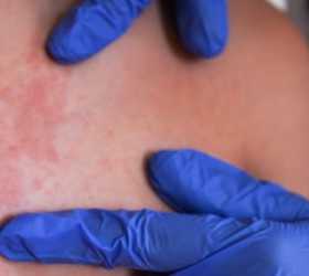 Casos de sarampo aumentam e ampliam alerta em São Paulo
