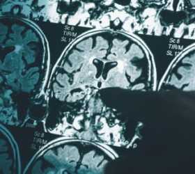 Pesquisa brasileira sobre Alzheimer ganha destaque mundial com prêmios internacionais